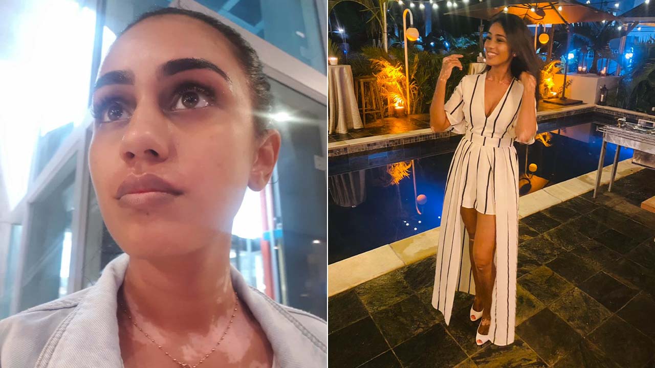 Yashmini Hazareesingh était mannequin plus jeune et souhaite se relancer malgré sa maladie.