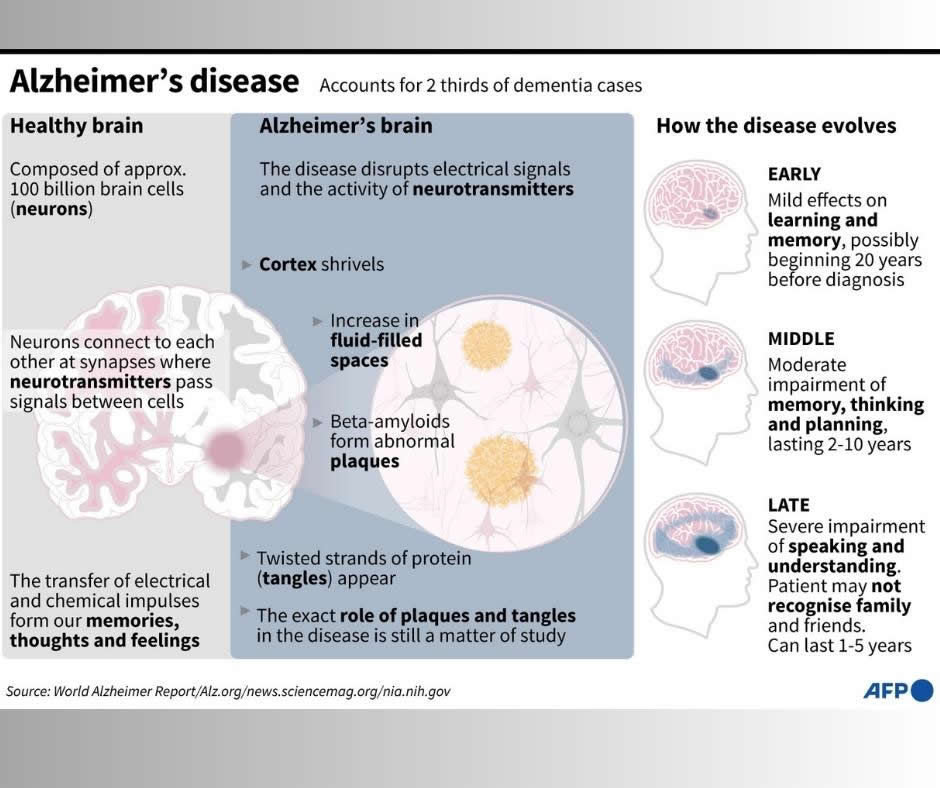 Alzheimer